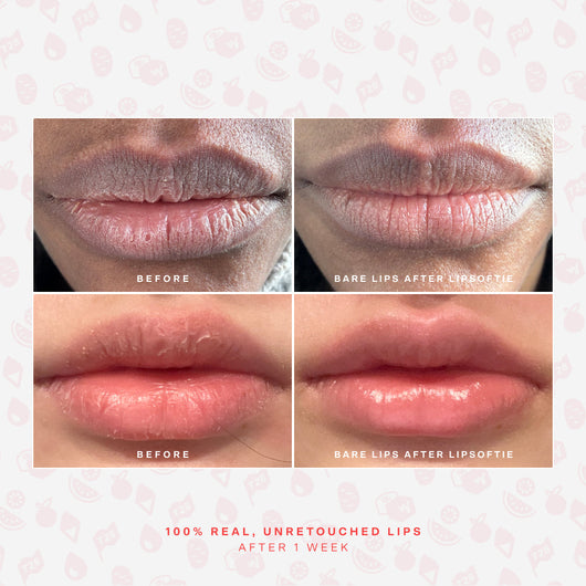 LipSoftie® Lip Treatment Set