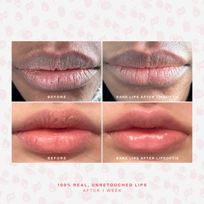 LipSoftie® Lip Treatment